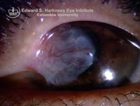 Symblepharon in a recurrent pterygium case.
